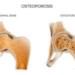 Home Care in Westfield NJ: Bones